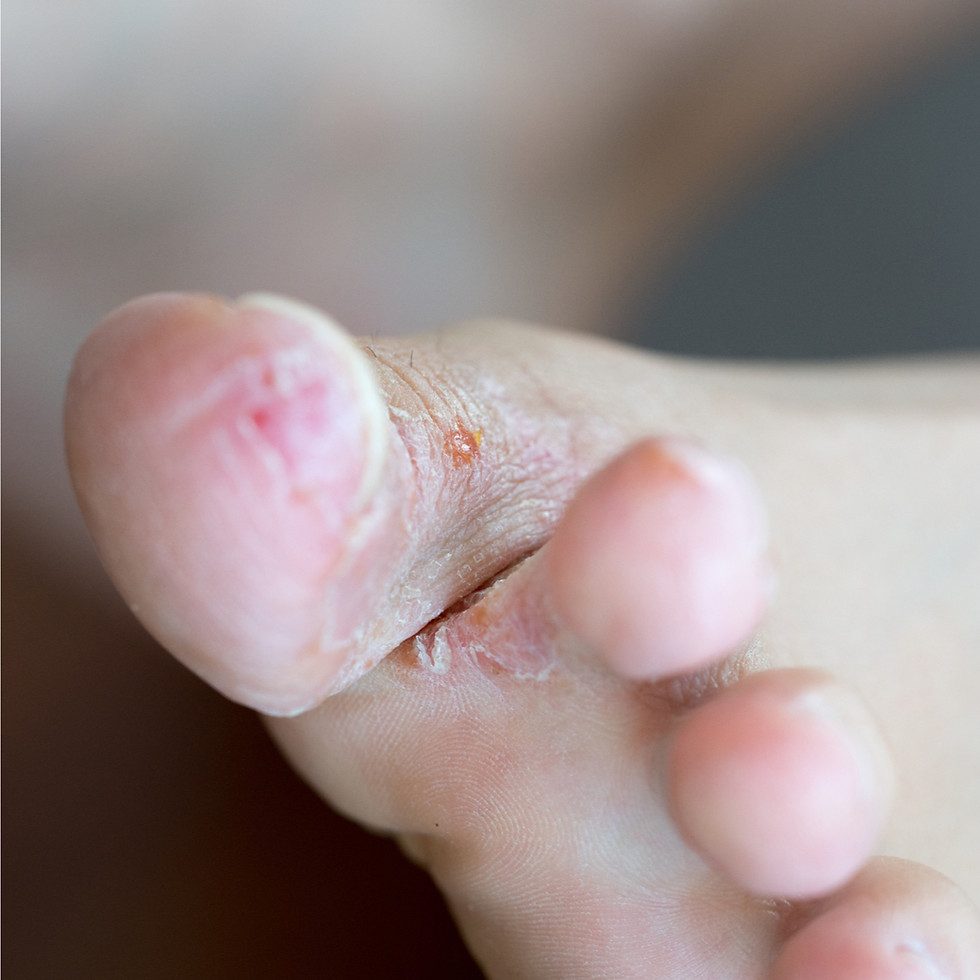 Thumbnail: Anti-Fungal Spray for Nail & Feet