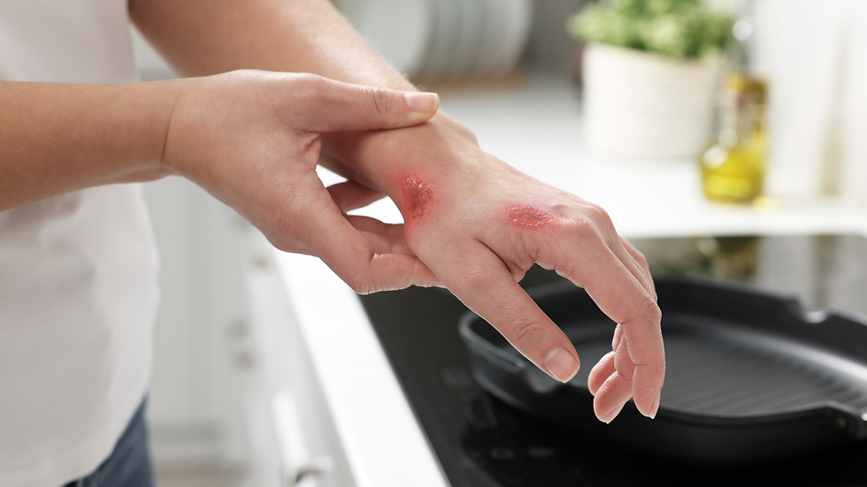 What to Do If You Burn Yourself in the Kitchen: Fast Relief with BioMist MD HOCl Burn & Wound Spray