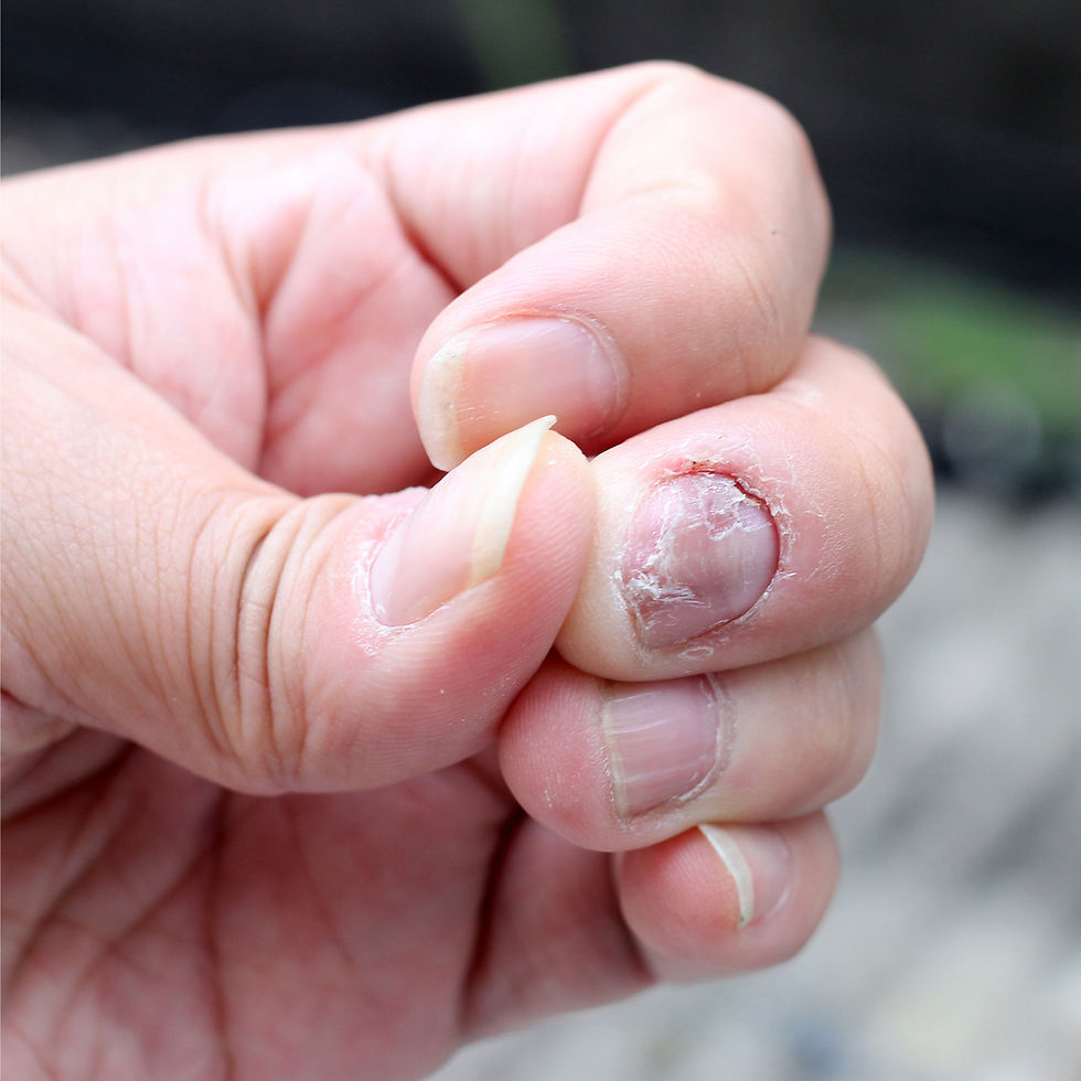 Thumbnail: Anti-Fungal Spray for Nail & Feet