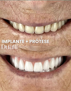 Prótese em Luziânia