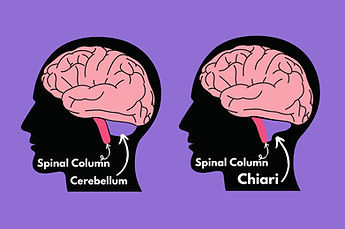 Chiari Malformation Example
