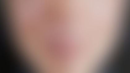 MELASMA