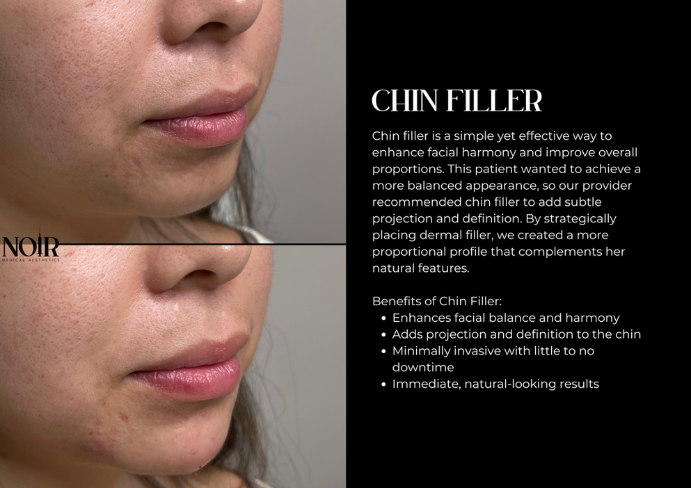 chin before and after, showcasing a correction improving projection.