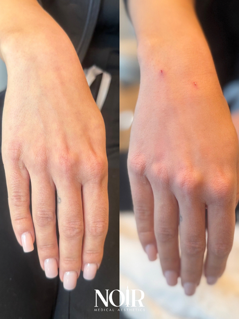 Hand Filler: What Your Visit Is Actually Like