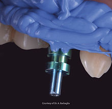 impression-implants (1).jpg