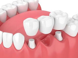 dental-bridge-300x225.jpg