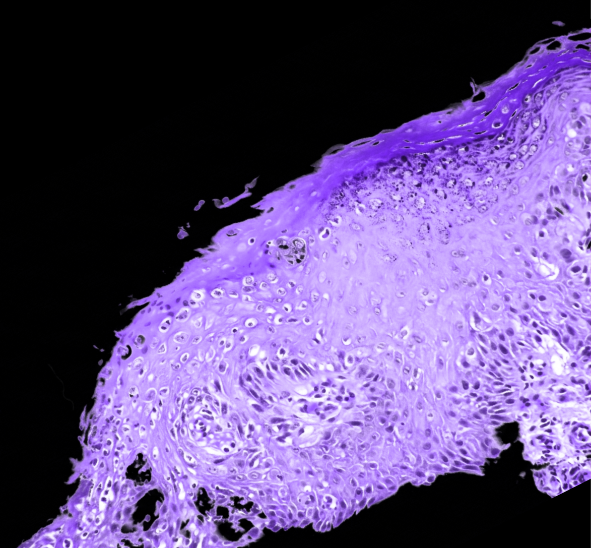 Hysterika - Breat Tissue Microscopic Sample