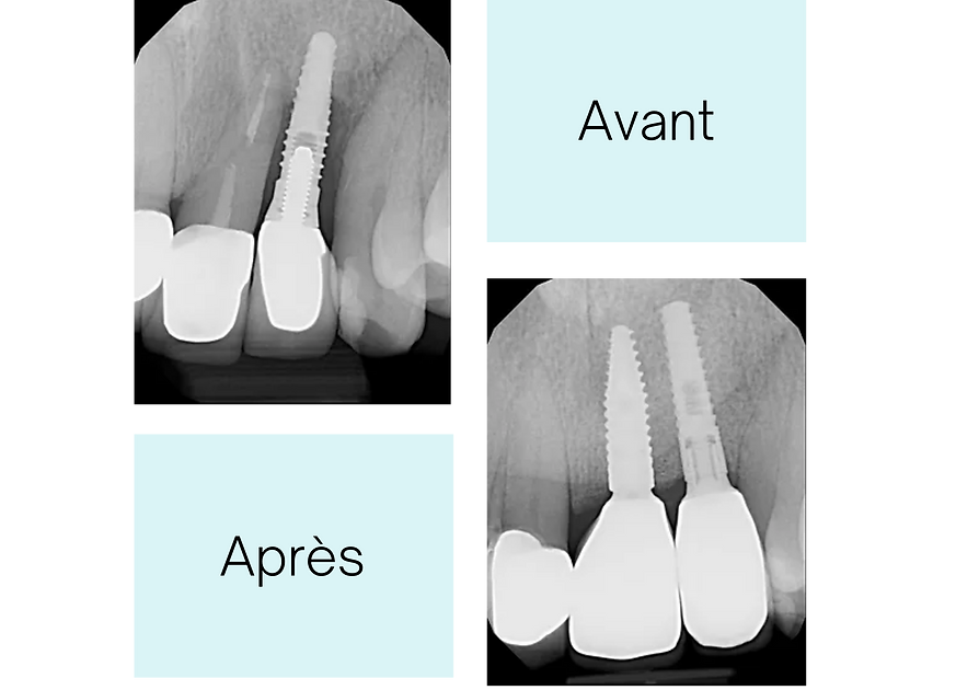 Implant video (13).png
