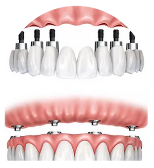 Implant video (11).png