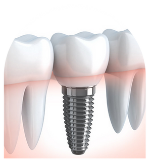 Implant video (9).png