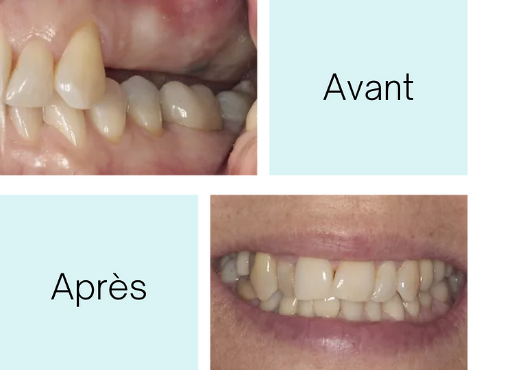 Implant video (14).png