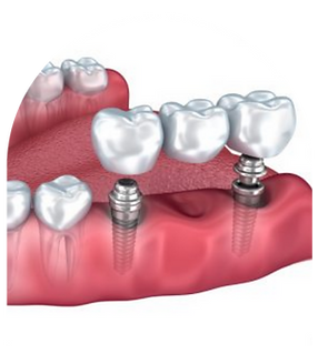 Implant video (10).png