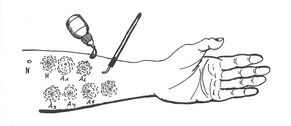 Allergische Symptome und Allergie Test