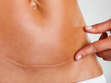 Without compression, KELOID SCARS appear.