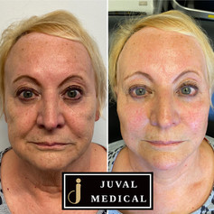 Full Face Lift.jpeg