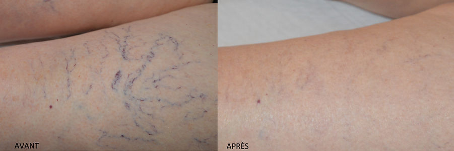 traitement des varicosités, traiter les petites veines sur les jambes, veines bleues sur les jambes, sclérothérapie, clinique médicale clément paradis