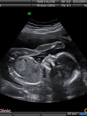 First photos of our baby girl!