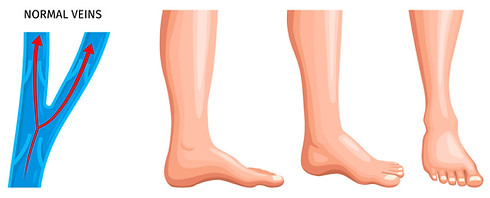vircose veins.jpg