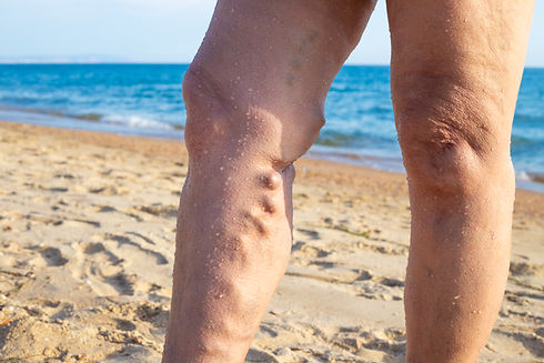 sick-female-legs-with-thrombophlebitis-bumps-against-backdrop-sea-sanatorium-resort-treatm