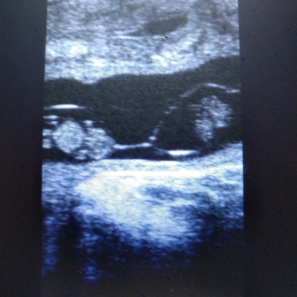 Ultraschallbild Kuh tragend Zwillinge