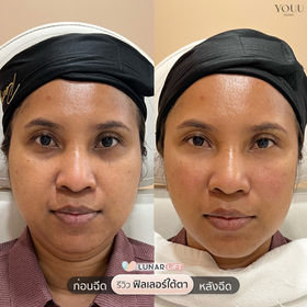 รีวิวฟิลเลอร์ใต้ตา เทคนิค LUNAR LiFT