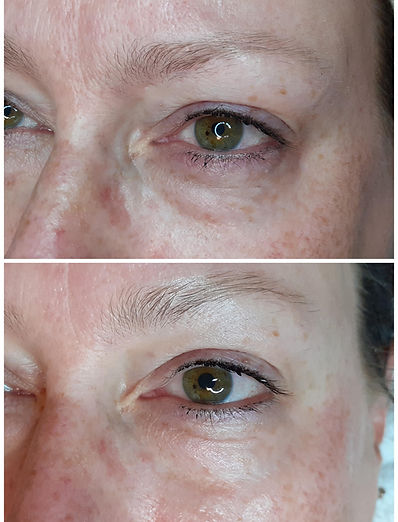 Microneedling vorher nachher in Winterthur | AB Dermalounge