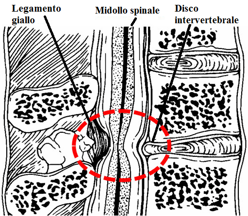 Stenosi_Spinale_Around_the_Game