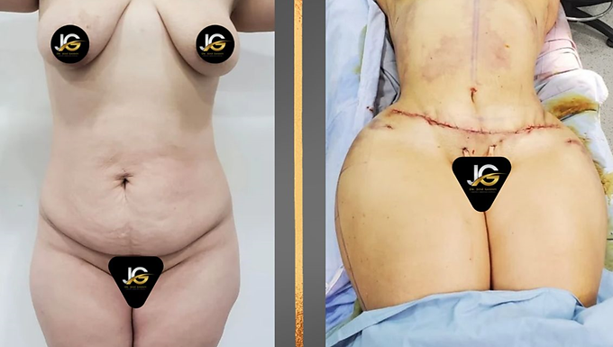 Abdominoplastia