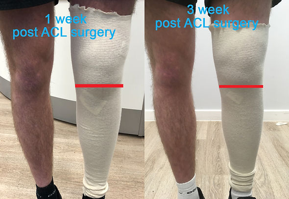 ACL physiolab and compex.jpg