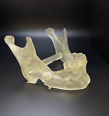 Mandible fracture.JPG