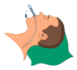 intubation et ventilation mécanique.PNG