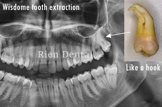Wisdom tooth extraction