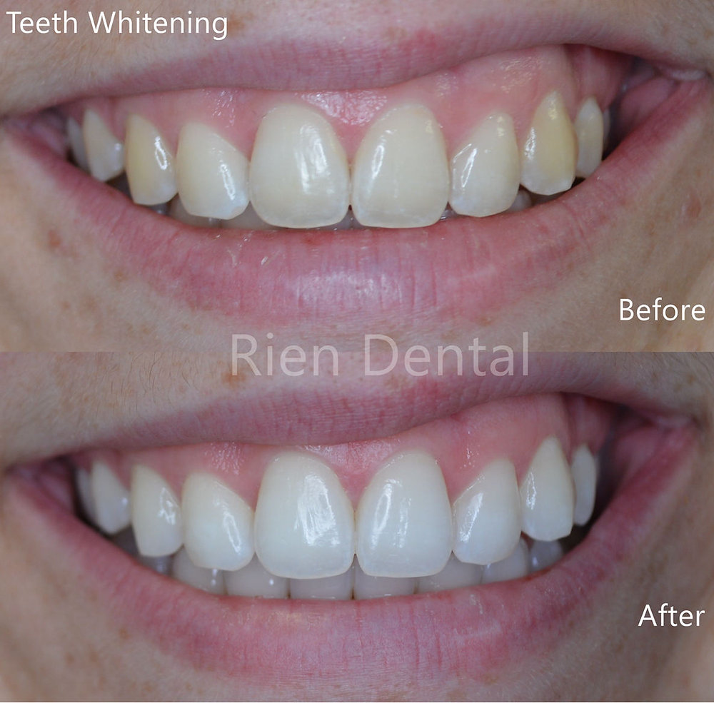 A whiter and brighter smile