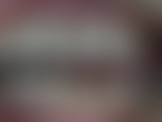 Dental implants treatment while taking bisphosphonates