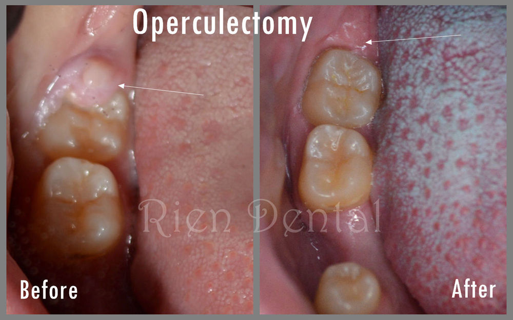 Operculectomy A Minor Surgery For Wisdom Teeth.