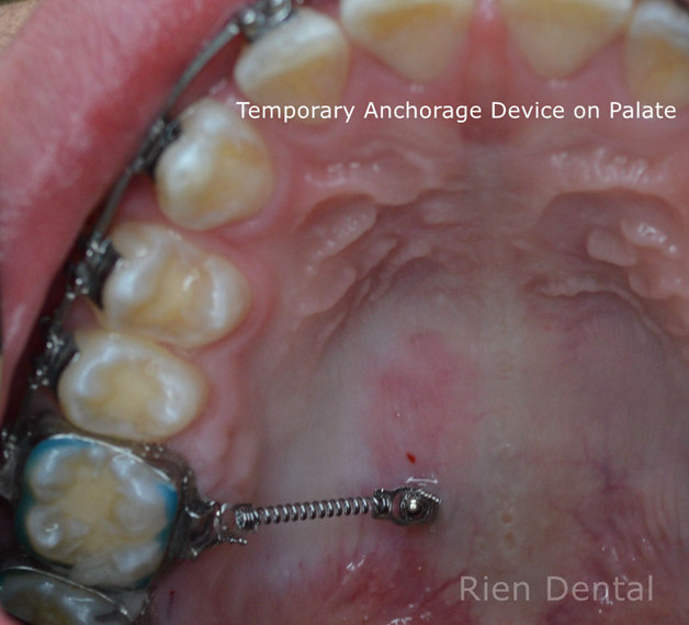 Temporary anchorage devices TADs