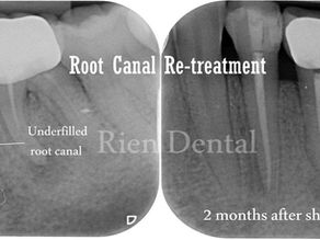 Root Canal Re-treatment