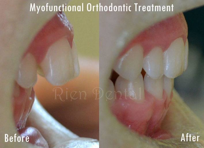 No braces orthodontic