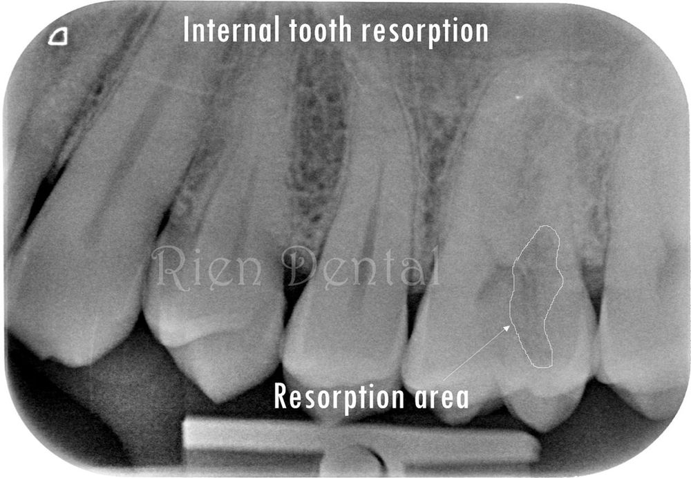 Internal tooth resorption root canal treatment with 5 canals.