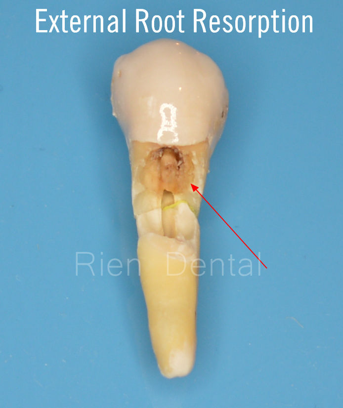 External Root Resorption.
