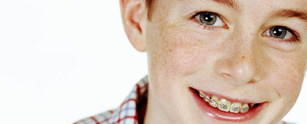 boy-with-braces.jpg