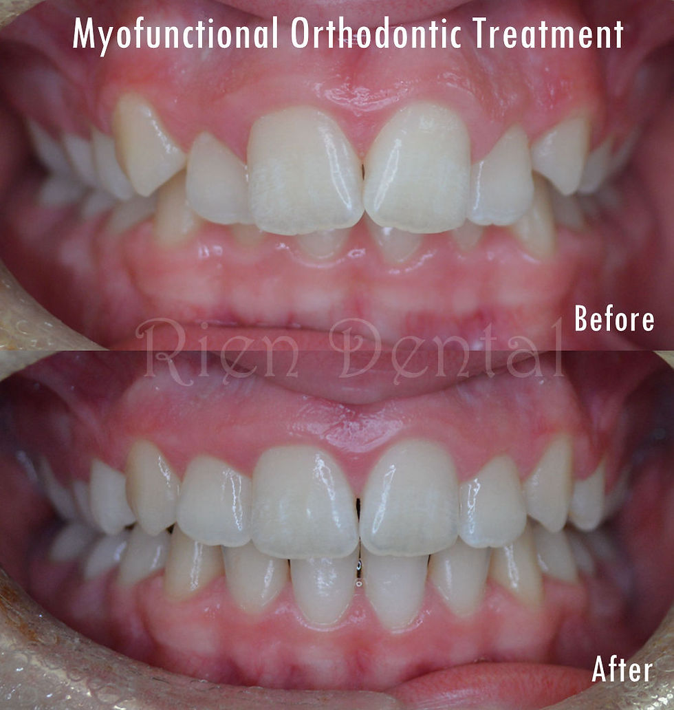 Myofunctional orthodontic