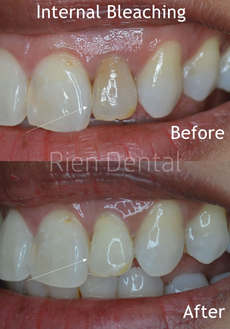 Internal bleaching after root canal treatment.