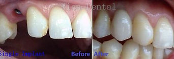 single dental implant