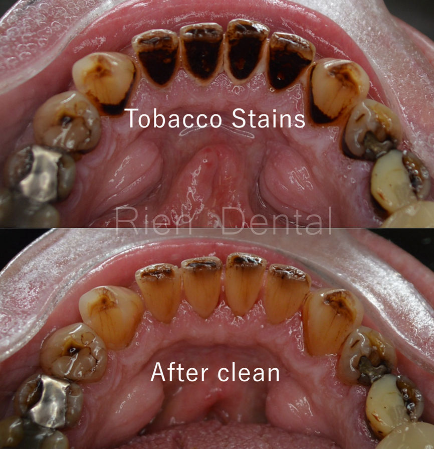 tobacco-stains-on-teeth