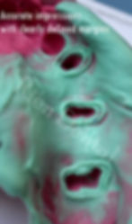 Dental impressions for crowns and bridges