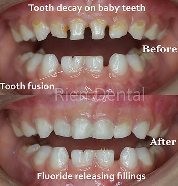 baby tooth decay