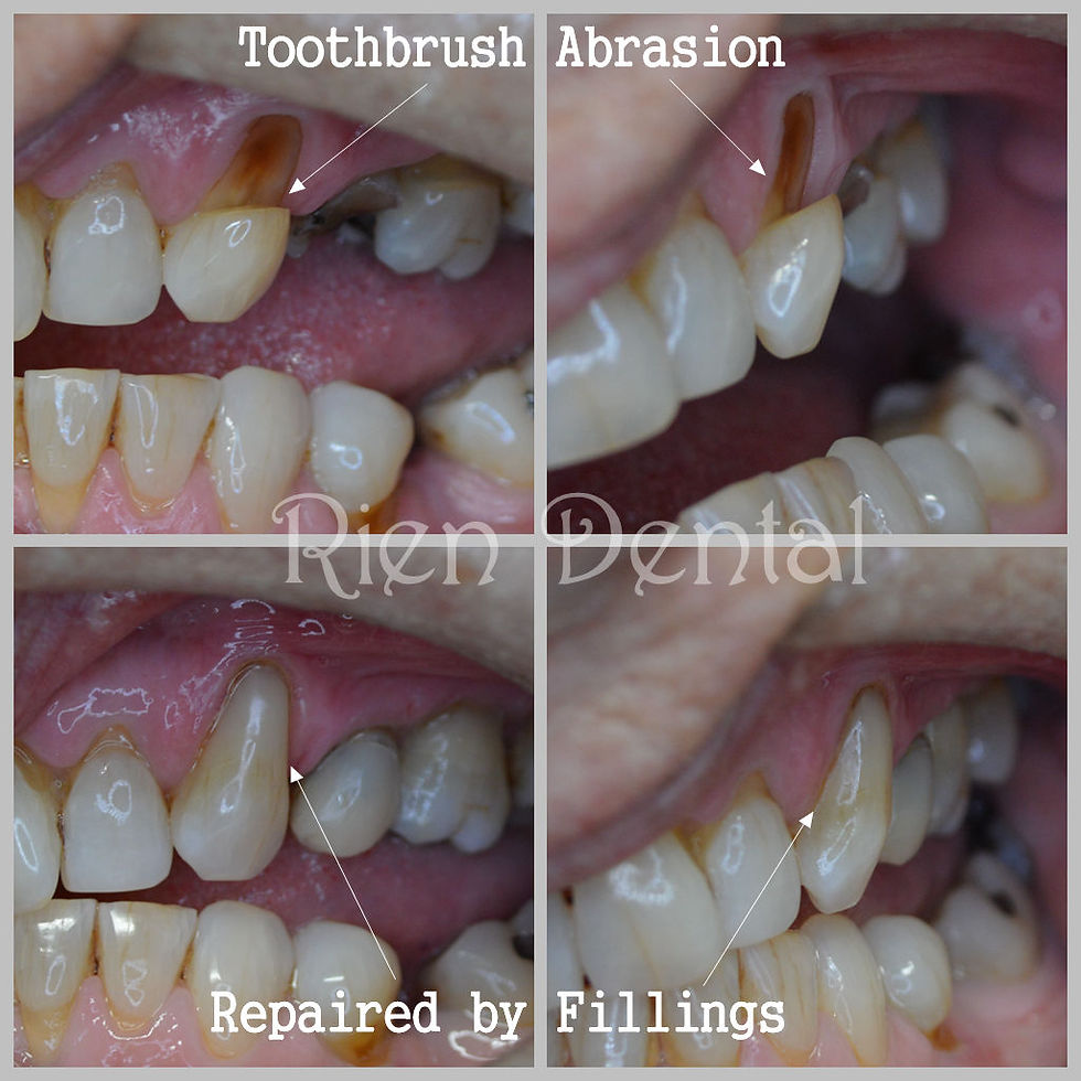 Toothbrush abrasion.