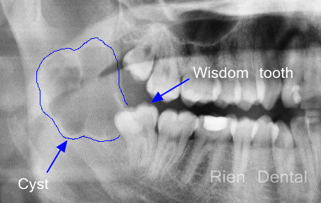 Impacted wisdom tooth with a cyst