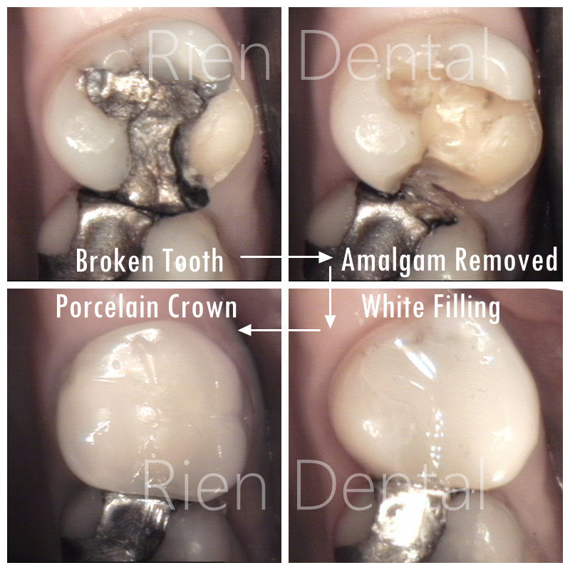 How to fix a broken tooth.